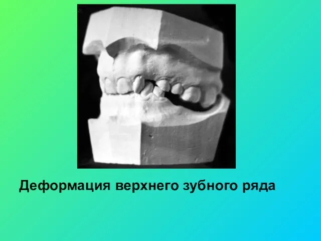 Деформация верхнего зубного ряда