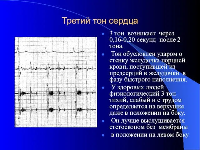 Третий тон сердца 3 тон возникает через 0,16-0,20 секунд после 2
