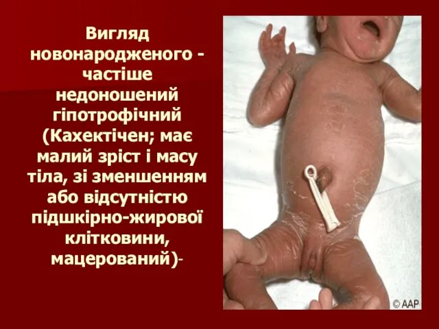Вигляд новонародженого -частіше недоношений гіпотрофічний (Кахектічен; має малий зріст і масу