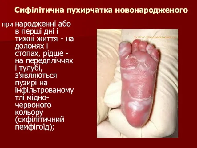 Сифілітична пухирчатка новонародженого при народженні або в перші дні і тижні