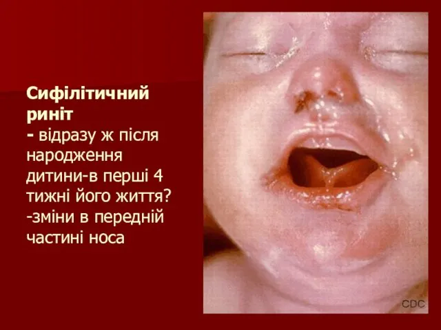 Сифілітичний риніт - відразу ж після народження дитини-в перші 4 тижні