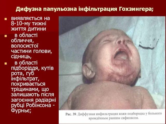 Дифузна папульозна інфільтрация Гохзингера; виявляється на 8-10-му тижні життя дитини в