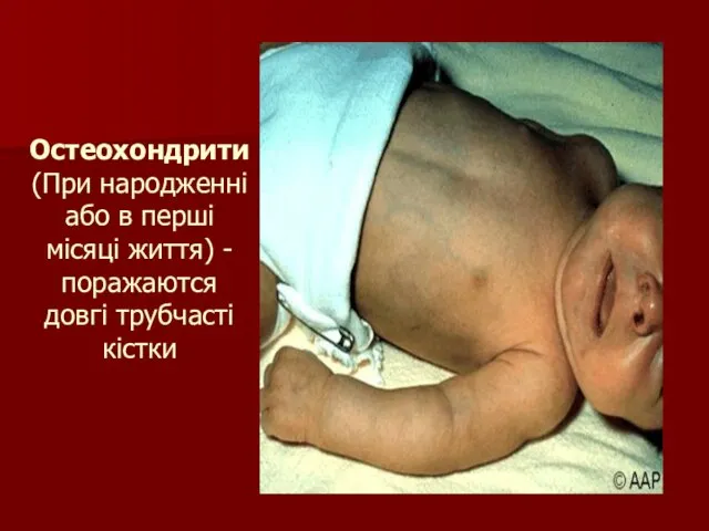 Остеохондрити (При народженні або в перші місяці життя) -поражаются довгі трубчасті кістки