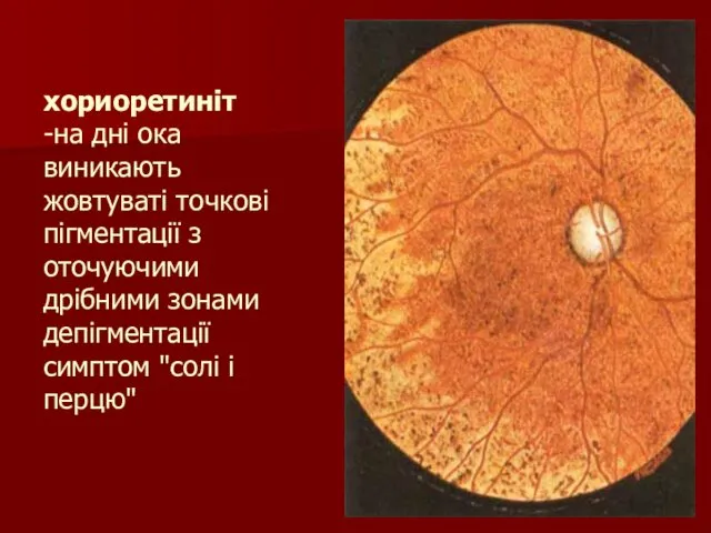 хориоретиніт -на дні ока виникають жовтуваті точкові пігментації з оточуючими дрібними