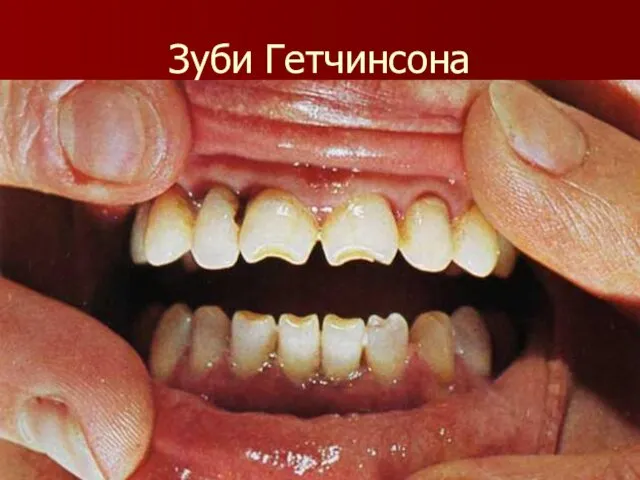 Зуби Гетчинсона