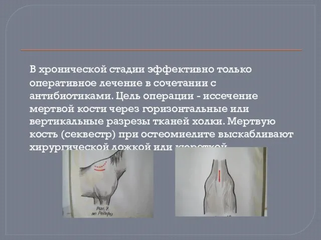 В хронической стадии эффективно только оперативное лечение в сочетании с антибиотиками.