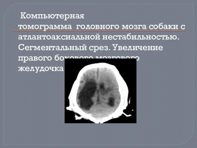 Компьютерная томограмма головного мозга собаки с атлантоаксиальной нестабильностью. Сегментальный срез. Увеличение правого бокового мозгового желудочка