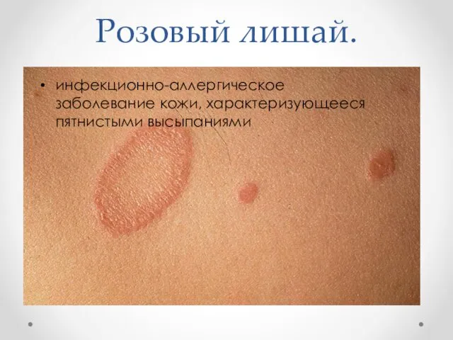 Розовый лишай. инфекционно-аллергическое заболевание кожи, характеризующееся пятнистыми высыпаниями