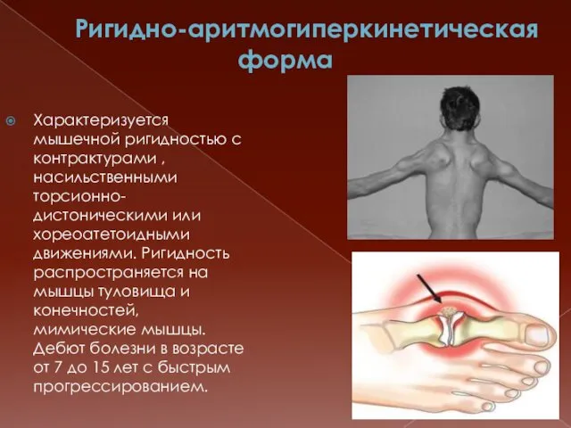 Ригидно-аритмогиперкинетическая форма Характеризуется мышечной ригидностью с контрактурами , насильственными торсионно-дистоническими или