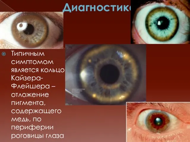 Диагностика Типичным симптомом является кольцо Кайзера-Флейшера – отложение пигмента, содержащего медь, по периферии роговицы глаза