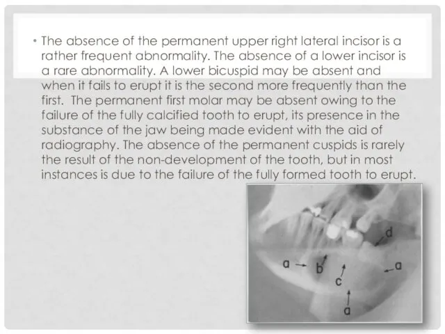 The absence of the permanent upper right lateral incisor is a