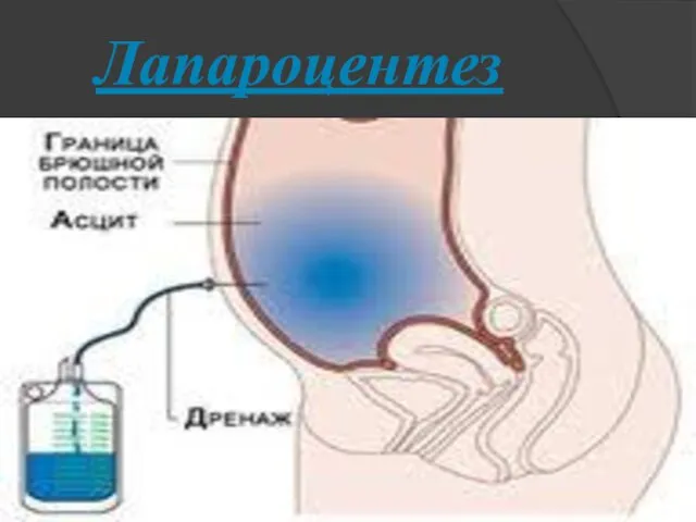 Лапароцентез