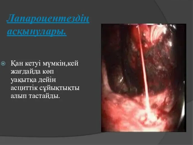 Лапароцентездің асқынулары. Қан кетуі мүмкін,кей жағдайда көп уақытқа дейін асциттік сұйықтықты алып тастайды.