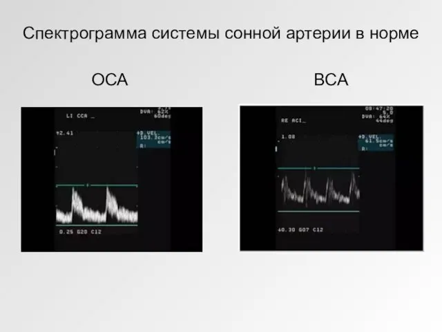 Спектрограмма системы сонной артерии в норме ОСА ВСА