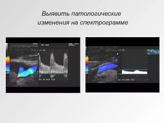 Выявить патологические изменения на спектрограмме