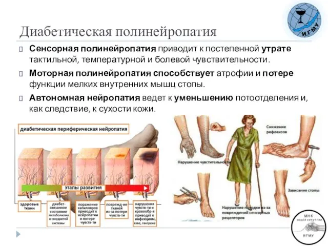 Диабетическая полинейропатия Сенсорная полинейропатия приводит к постепенной утрате тактильной, температурной и