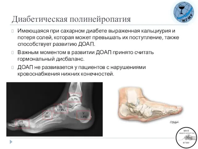 Диабетическая полинейропатия Имеющаяся при сахарном диабете выраженная кальциурия и потеря солей,