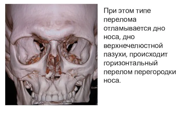 При этом типе перелома отламывается дно носа, дно верхнечелюстной пазухи, происходит горизонтальный перелом перегородки носа.