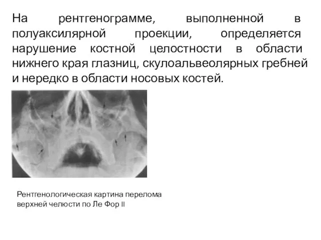 На рентгенограмме, выполненной в полуаксилярной проекции, определяется нарушение костной целостности в