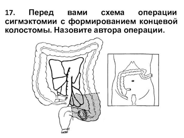 17. Перед вами схема операции сигмэктомии с формированием концевой колостомы. Назовите автора операции.