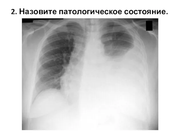 2. Назовите патологическое состояние.