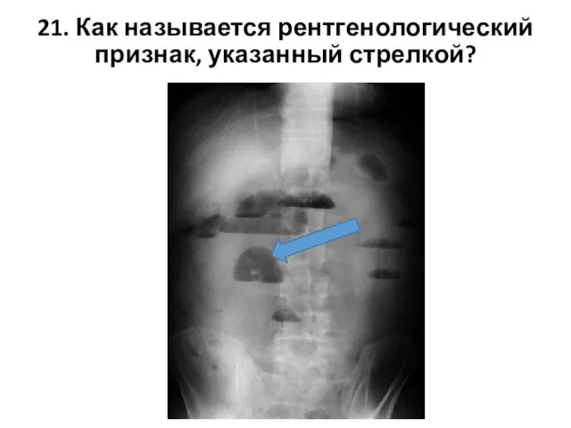 21. Как называется рентгенологический признак, указанный стрелкой?