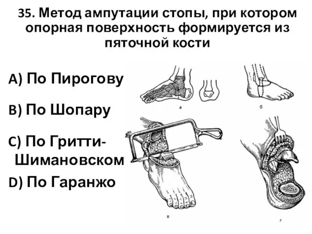 35. Метод ампутации стопы, при котором опорная поверхность формируется из пяточной