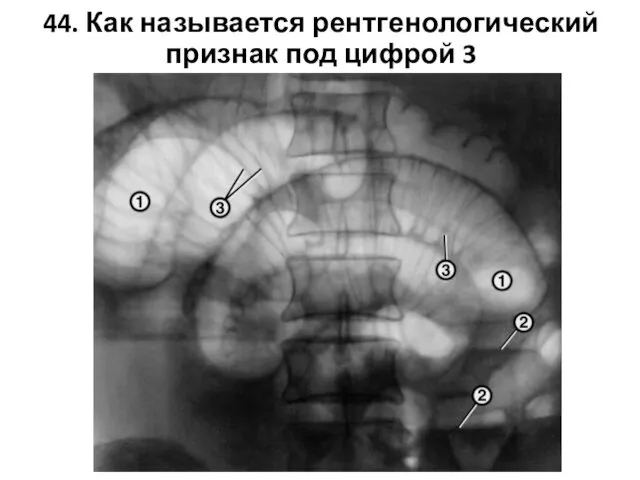 44. Как называется рентгенологический признак под цифрой 3