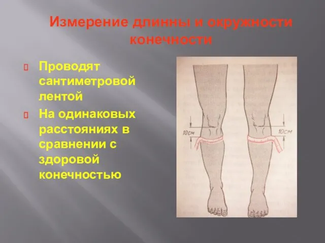 Измерение длинны и окружности конечности Проводят сантиметровой лентой На одинаковых расстояниях в сравнении с здоровой конечностью