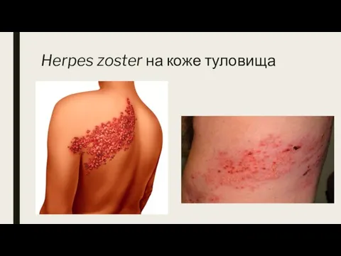 Herpes zoster на коже туловища