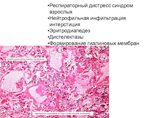 Респираторный дистресс синдром взрослых Нейтрофильная инфильтрация интерстиция Эритродиапедез Дистелектазы Формирование гиалиновых мембран ЛЕГКИЕ