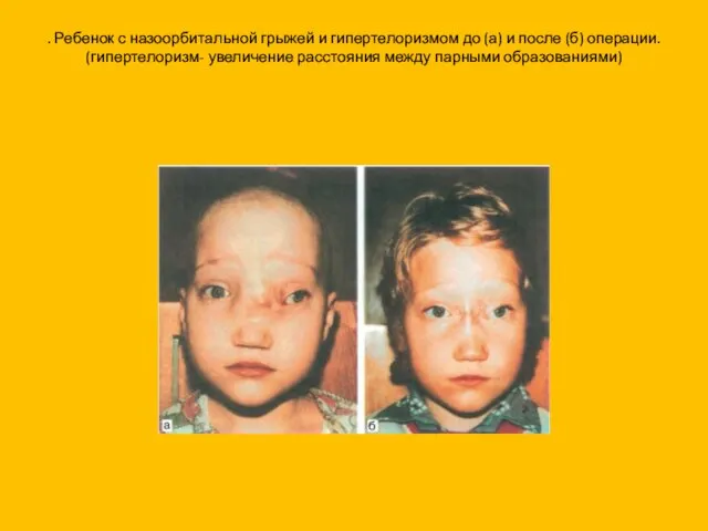 . Ребенок с назоорбитальной грыжей и гипертелоризмом до (а) и после