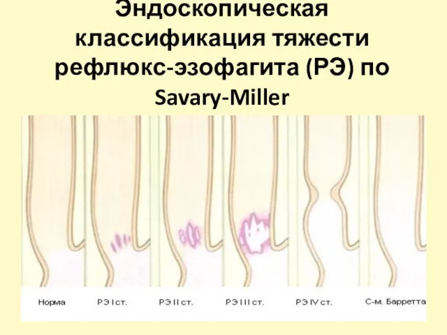 Эндоскопическая классификация тяжести рефлюкс-эзофагита (РЭ) по Savary-Miller