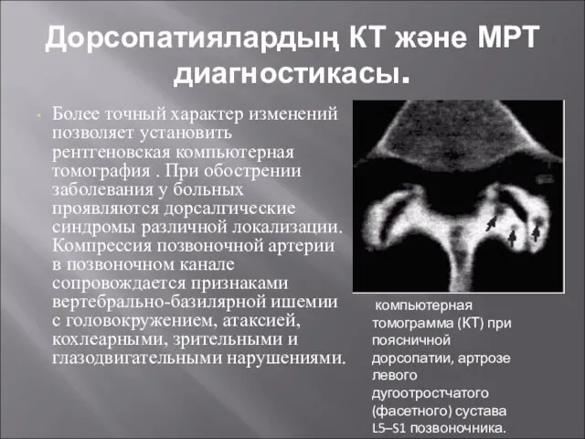 Дорсопатиялардың КТ және МРТ диагностикасы. Более точный характер изменений позволяет установить