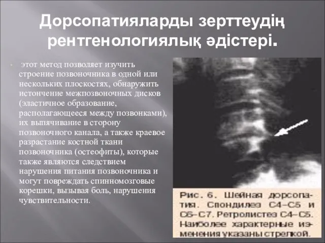 Дорсопатияларды зерттеудің рентгенологиялық әдістері. этот метод позволяет изучить строение позвоночника в