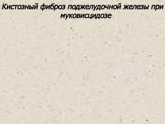 Кистозный фиброз поджелудочной железы при муковисцидозе