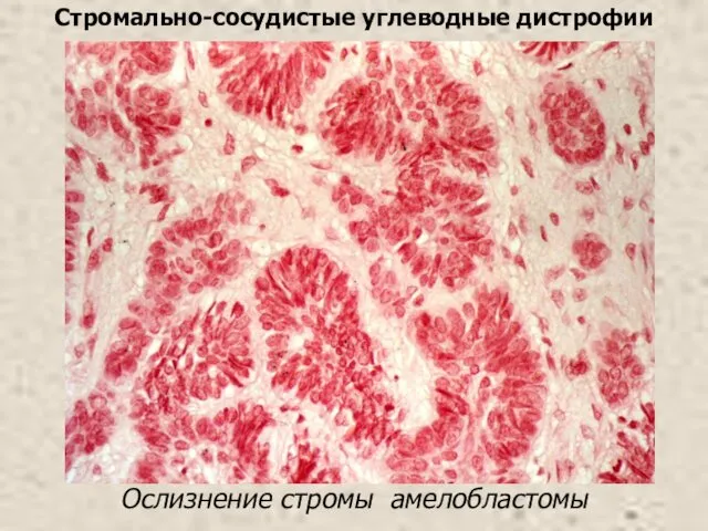 Ослизнение стромы амелобластомы Стромально-сосудистые углеводные дистрофии