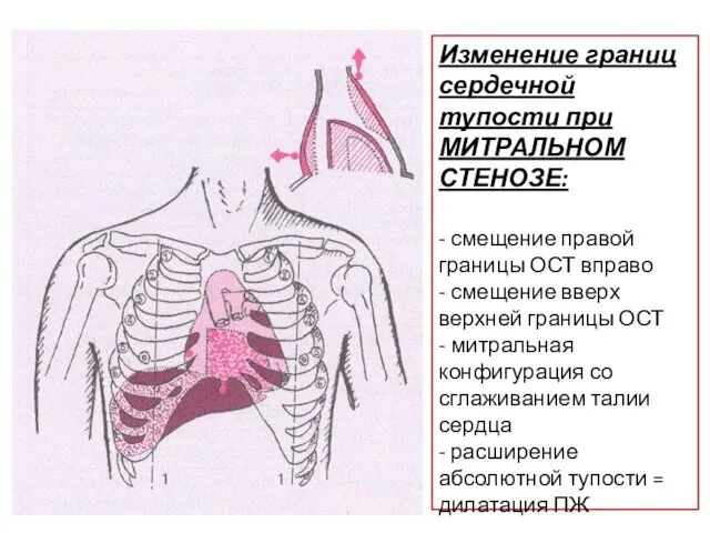 Изменение границ сердечной тупости при МИТРАЛЬНОМ СТЕНОЗЕ: - смещение правой границы