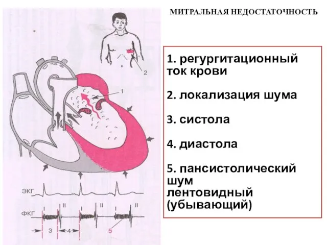 1. регургитационный ток крови 2. локализация шума 3. систола 4. диастола