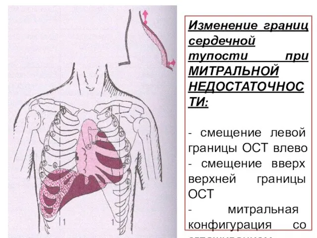 Изменение границ сердечной тупости при МИТРАЛЬНОЙ НЕДОСТАТОЧНОСТИ: - смещение левой границы