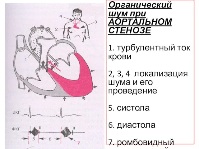 Органический шум при АОРТАЛЬНОМ СТЕНОЗЕ 1. турбулентный ток крови 2, 3,