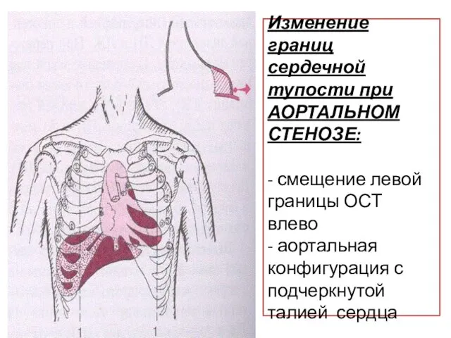 Изменение границ сердечной тупости при АОРТАЛЬНОМ СТЕНОЗЕ: - смещение левой границы