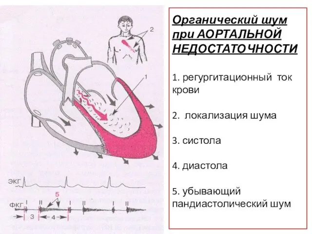 Органический шум при АОРТАЛЬНОЙ НЕДОСТАТОЧНОСТИ 1. регургитационный ток крови 2. локализация