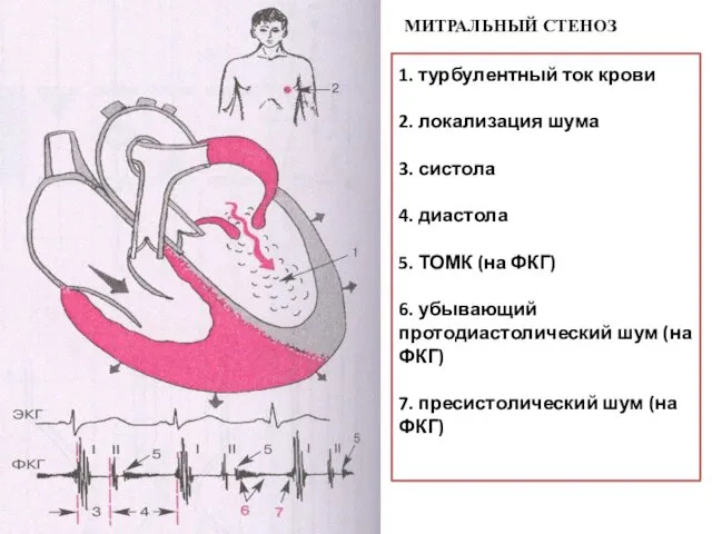 1. турбулентный ток крови 2. локализация шума 3. систола 4. диастола