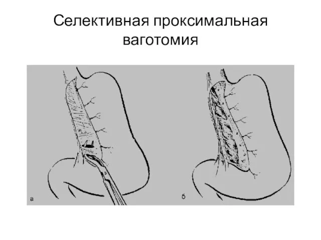 Селективная проксимальная ваготомия