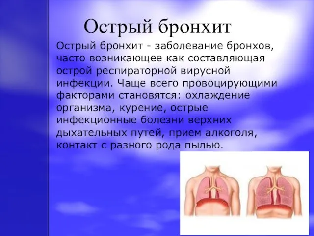 Острый бронхит Острый бронхит - заболевание бронхов, часто возникающее как составляющая