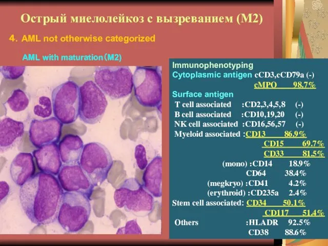 Острый миелолейкоз с вызреванием (М2) Immunophenotyping Cytoplasmic antigen cCD3,cCD79a (-) cMPO