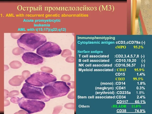 Острый промиелолейкоз (М3) Immunophenotyping Cytoplasmic antigen cCD3,cCD79a (-) cMPO 95.2% Surface