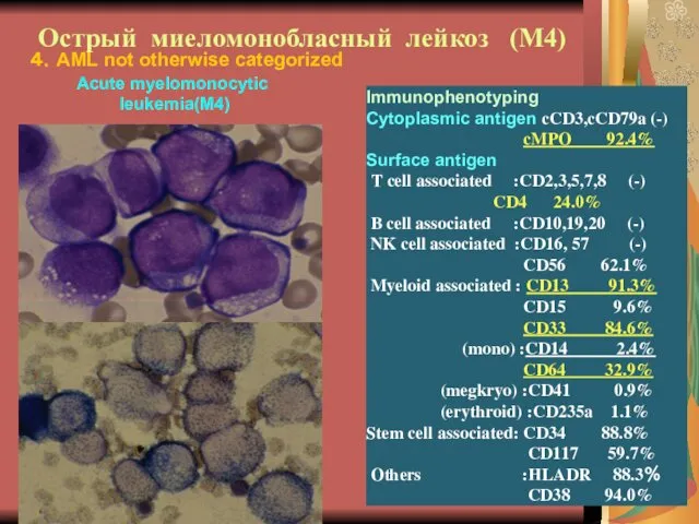 Острый миеломонобласный лейкоз (М4) Immunophenotyping Cytoplasmic antigen cCD3,cCD79a (-) cMPO 92.4%