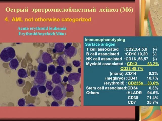 Острый эритромиелобластный лейкоз (М6) Immunophenotyping Surface antigen T cell associated :CD2,3,4,5,8